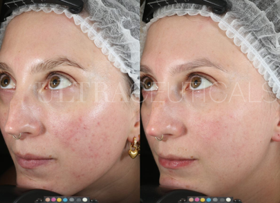 Ultraceuticals R.E.D. Corrective Serum Rosacea Edgeless Beauty Pro Before and After